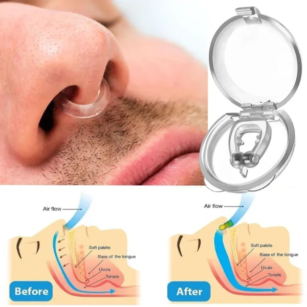 Anti-Snoring Corrector Snore Prevention Gadget - Image 3