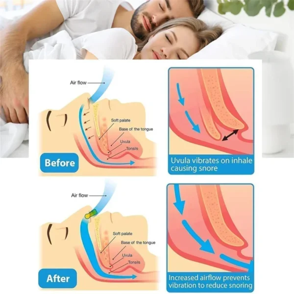 Anti-Snoring Corrector Snore Prevention Gadget - Image 4